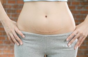 Cảnh Báo Về Sẹo Ác Quỷ (Tư Liệu Y Khoa)