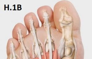 „Mẹo Vặt“ loại bỏ nhanh và dứt điểm chứng đau: „Gai Gót Chân“ (Viêm Cân Can Bàn Chân)- Tư liệu Y Khoa