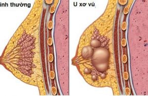 DỤC- TUYỆT- CÂN- PHONG ĐẢ “LỔN NHỔN”